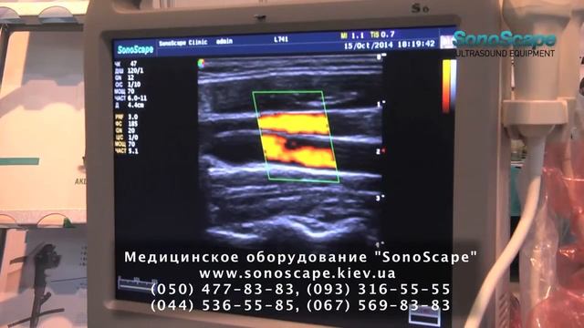 Ультразвуковая диагностика компании SonoScape
