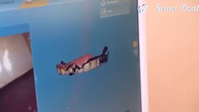 Как мы делаем виниры