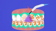Отбеливание зубов системой KLOX | Механизм отбеливания зубов | Cтоматология Зуб.ру