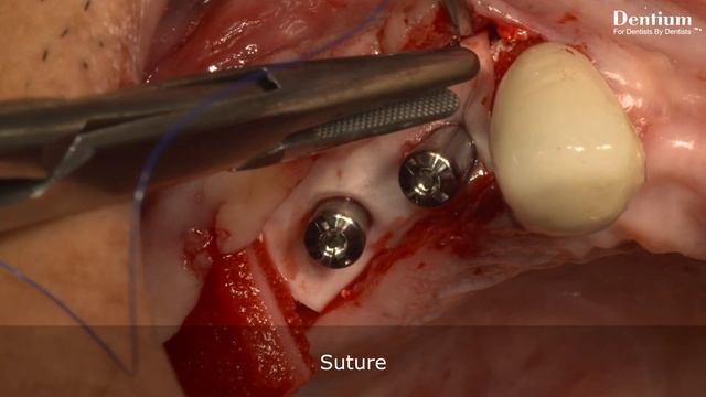 Both sinus augmentation of the two approaches using Dentium regeneration materials