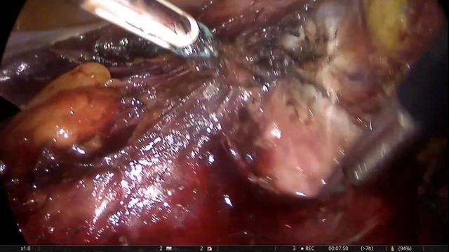 #Total laparoscopic hysterectomy#лапараскопическая гистерэктомия