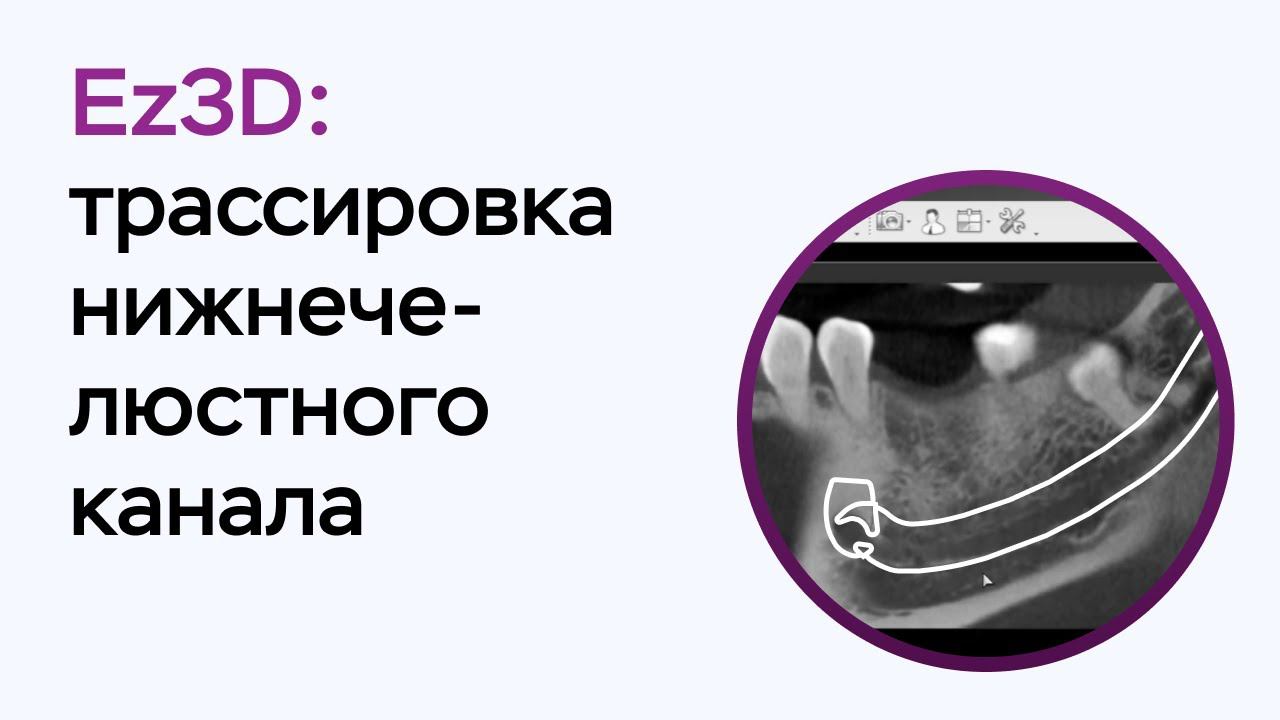 Возможности программы Ez3D: трассировка нижнечелюстного канала