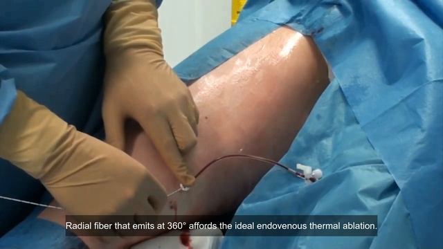 Looking for a quick and effective way to get rid of varicose veins?