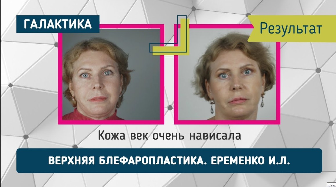 Верхняя блефаропластика фото до и после | Еременко Ирина Леонидовна