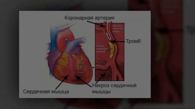 Диабетические Осложненения Часть 1.
