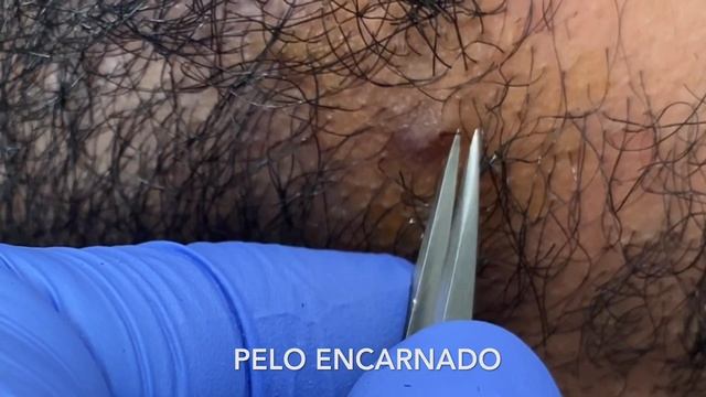 PELO ENCARNADO
