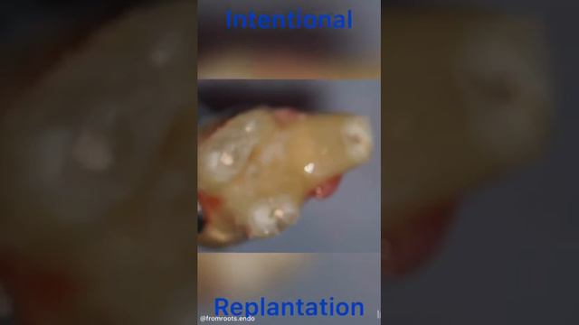 Преднамеренная реплантация 🇷🇺Intentional replantation 🇺🇸