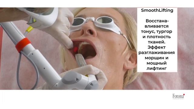 FOTONA лифтинг губ и периоральной зоны (зона рта)