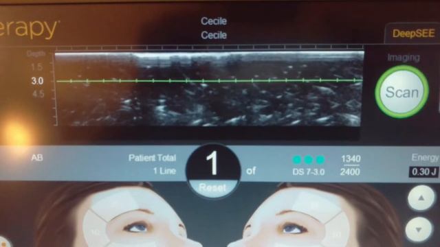 Merz Aesthetics Ulthera System Machine Ultherapy Ultrasound