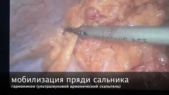 эндовидеохирургическая фенестрация кисты печени