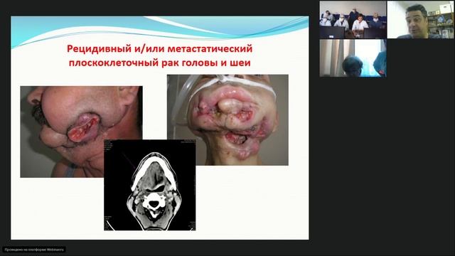 Опухоли головы и шеи