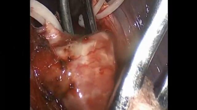 Торакоскопическая сегментэктомия при абсцессе легкого. Thoracoscopic segmentect lung abscess.