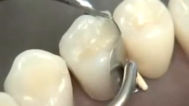 Препарирование по Блэку 2 класс
