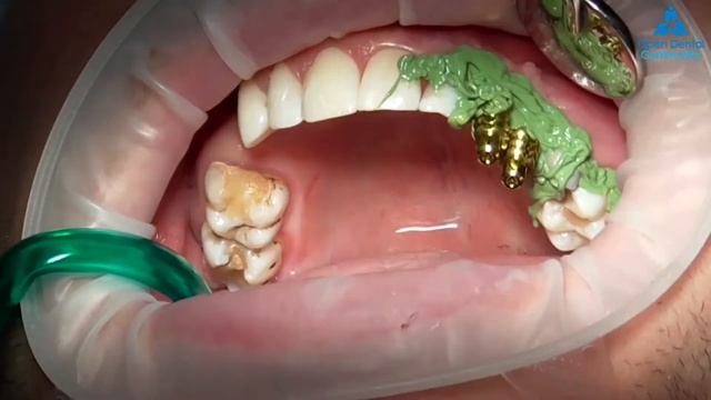 Имплантация и временные коронки на мульти юнит абатментах | Стоматология