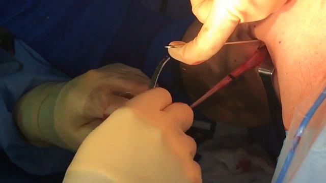 Dr.Christopher S. Lee performs a mini-open subpectoralis biceps tenodesis