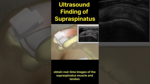 Ultrasound is The Key To Diagnosing Rotator Cuff. Supraspinatus