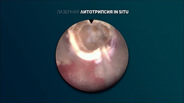 Лазерная литотрипсия. Видео 1.
