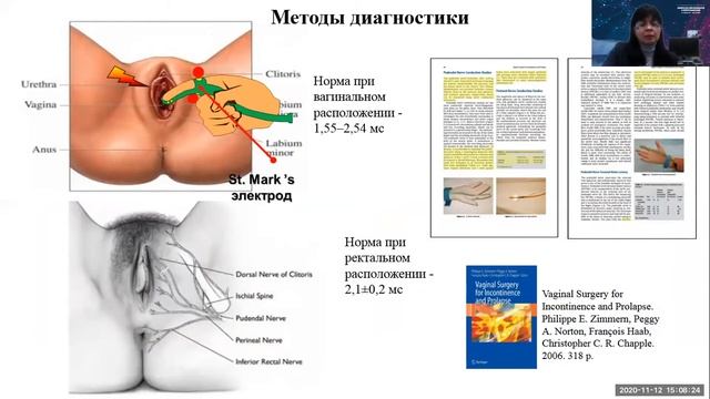Поздние феномены при стимуляционной ЭМГ полового нерва. Фоменко.О.Ю.