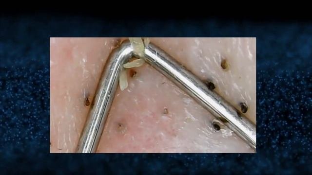 ЧЕРНЫЕ ТОЧКИBLACKHEAD Removal