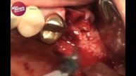 Sinus all kit