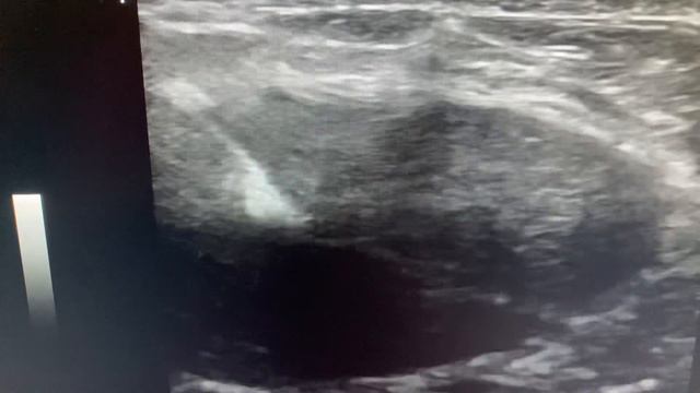 FNAC breast lump ( BIRADS 3 on ultrasound - Fibroadenoma)