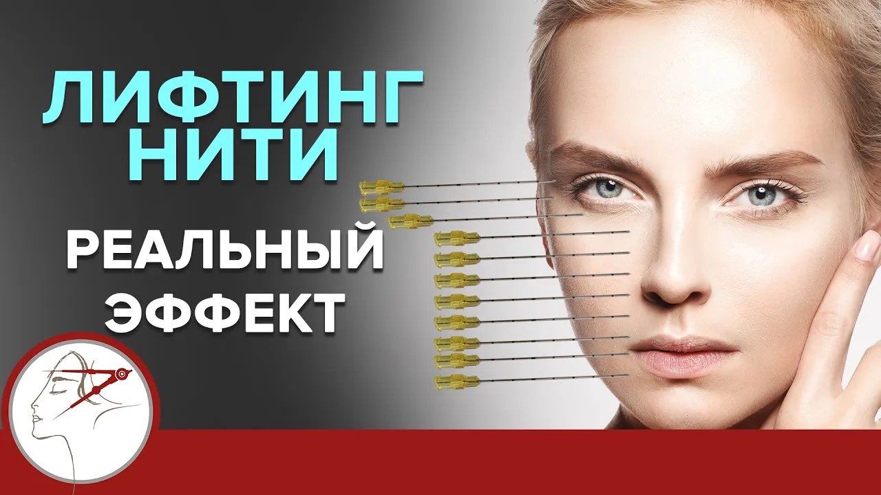 Нитевой лифтинг. Реальные результаты. Омоложение лица