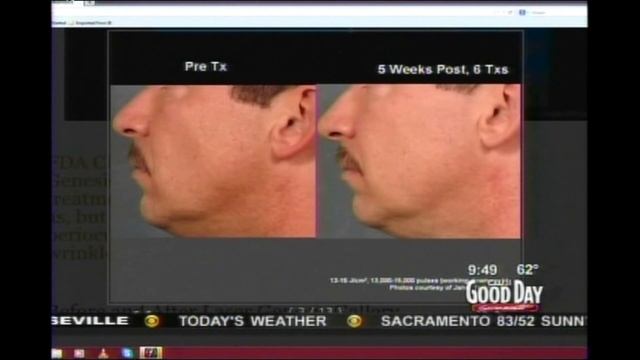 Good Day Sacramento Excel V & Laser Genesis Segment