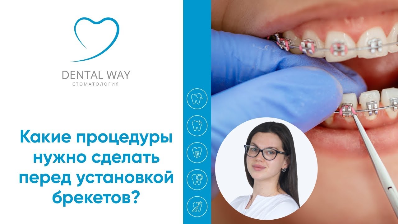 Какие процедуры нужно сделать перед установкой брекетов #Shorts.mp4
