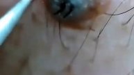 Удаление вросшего волоса в домашних условиях/Removal of ingrown hair at home