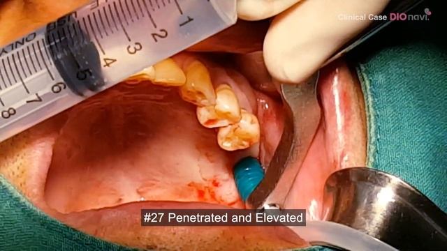 Sinus augmentation for multiple implants : flapless crestal approach
