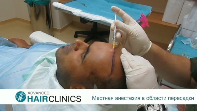 Пересадка волос методом FUE, шаг за шагом, доктор Анастасиос Векрис