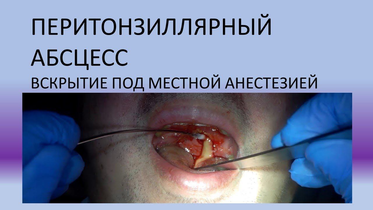 паратонзиллярный перитонзиллярный абсцесс горла нёбных миндалин абсцесс гланд при хроническом тонзил