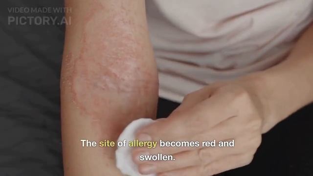 why we get allergies?