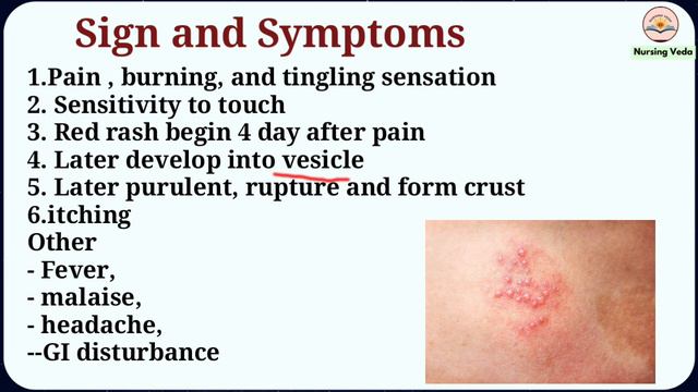 Herpes Zoster In Hindi | Shingles | Viral Skin Infection | Symptoms, Pathophysiology, Treatment