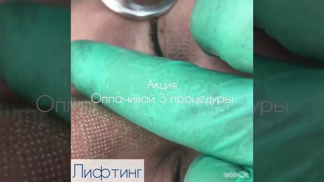 Фракционный фототермолиз | Лазерная клиника Аврора г Краснодар