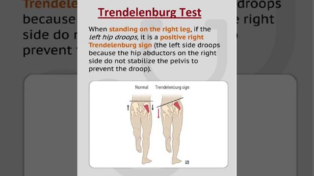Tест Tренделенбурга (Trendelenburg Test)!
