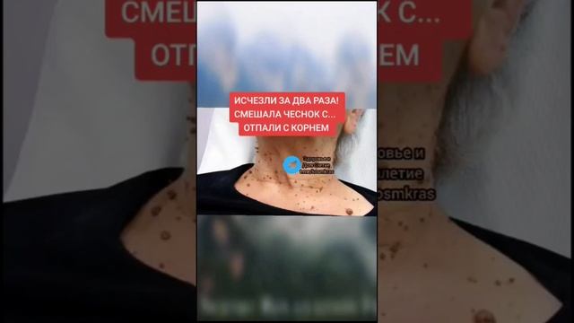 исчезли за два раза смешала чеснок с #народнаямедицина #долголетие #здоровье #медицина #зож #здоров