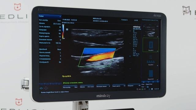 Протокол УЗИ. Работа функции iWorks на примере Mindray DC-60 Pro