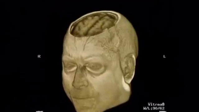 Лечение нарушений координации движения в Израиле