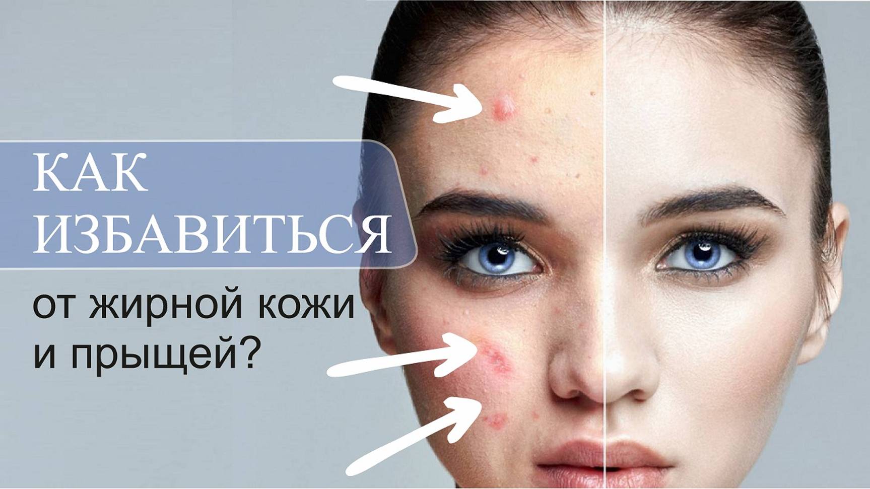 Как избавиться от жирной кожи и прыщей на теле?