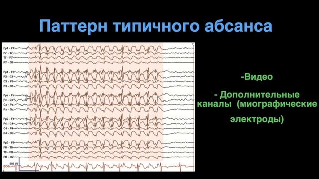 Паттерн эпилептического приступа на ЭЭГ