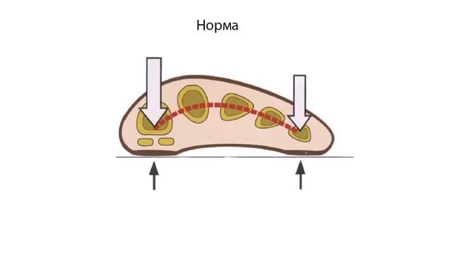 Как избавиться от косточки или шишки на большом пальце стопы / Hallux Valgus