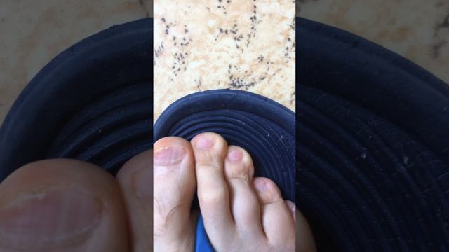 149-й день лечения ног от грибка ногтей