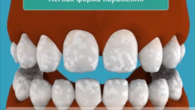 Флюороз