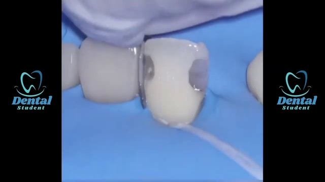 Class III composite Restoration  anterior composite restoration