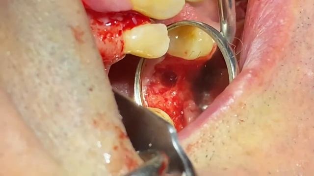 CRESTAL SINUS LIFT ACCESS