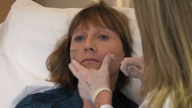 Non-surgical facelift (the Y-Lift) with Restylane Sub-Q Dermal filler | The Cosmetic Skin Clinic