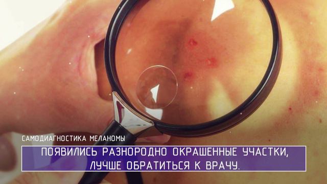 Самодиагностика меланомы