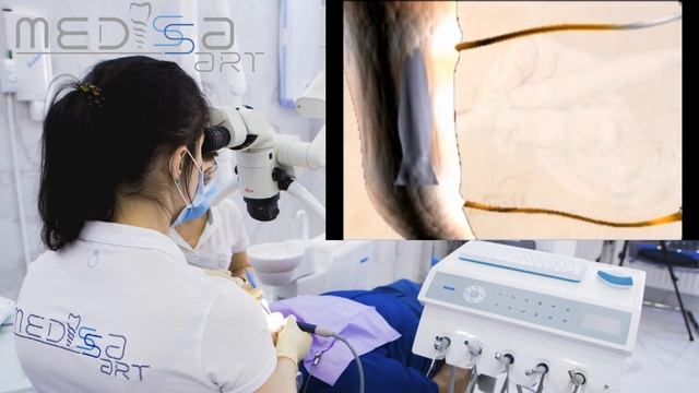 Пломбирование корневого канала системой BeeFill