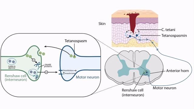 Clostridium Tetani for the USMLE Step 1